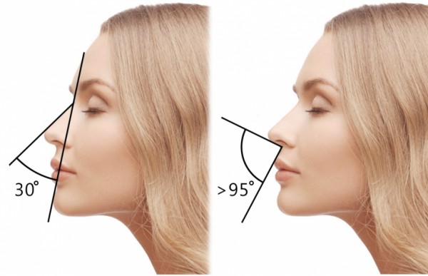 Инъекционная ринопластика для коррекции носа без операций